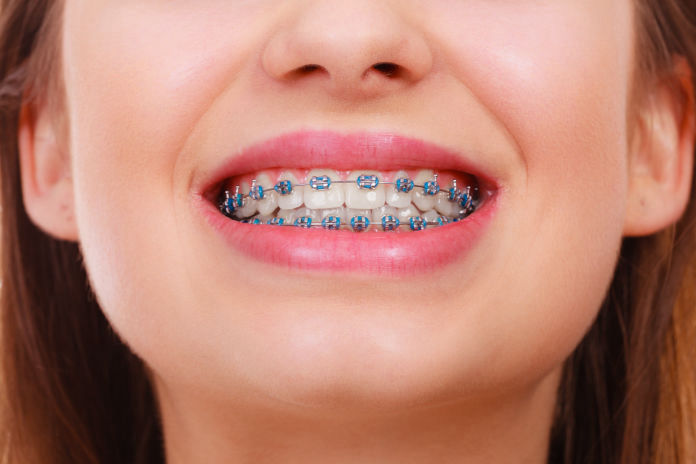 Braces