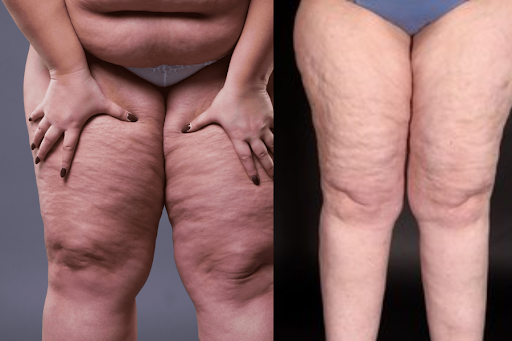 celebrities with lipedema